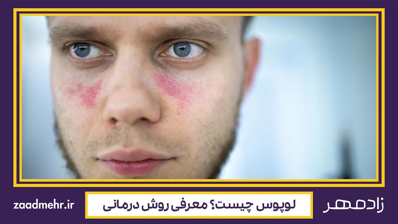 معرفی بیماری و درمان لوپوس