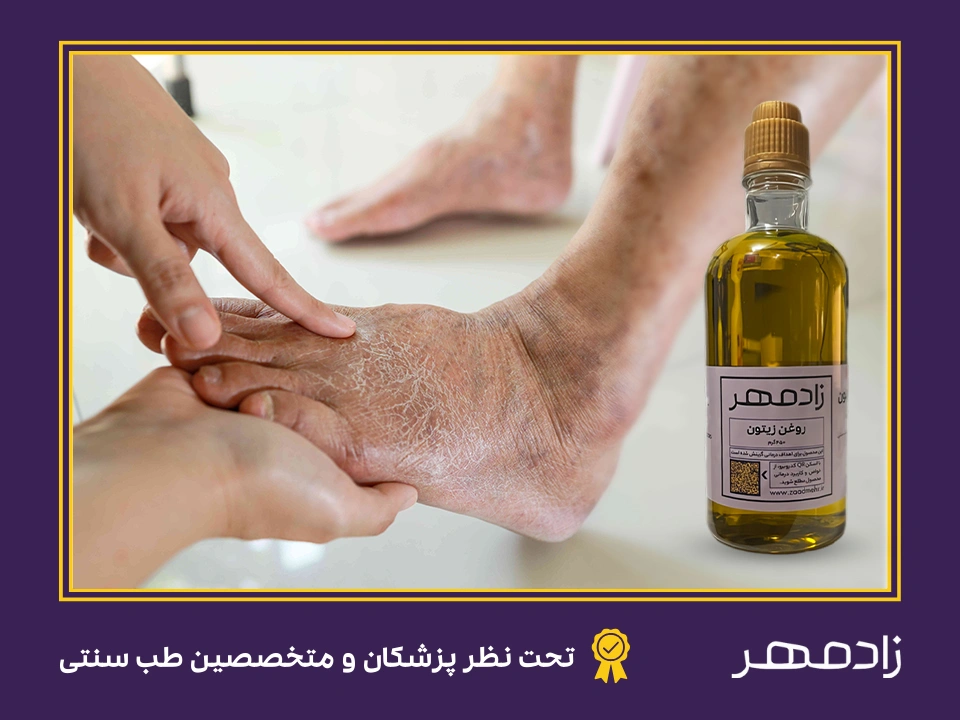 درمان زخم پای دیابتی با روغن زیتون - Treatment of diabetic foot ulcers with olive oil