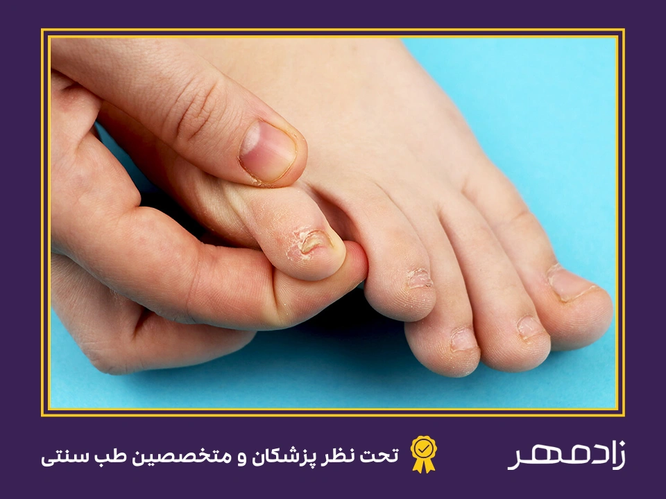 عفونت قارچی انگشت پا - Fungal infection feet finger
