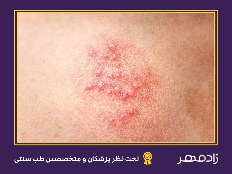بیماری تبخال تناسلی - Genital herpes disease