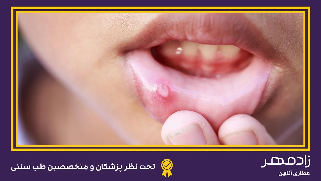 بیماری آفت دهان در کودکان - Canker sores disease in kids