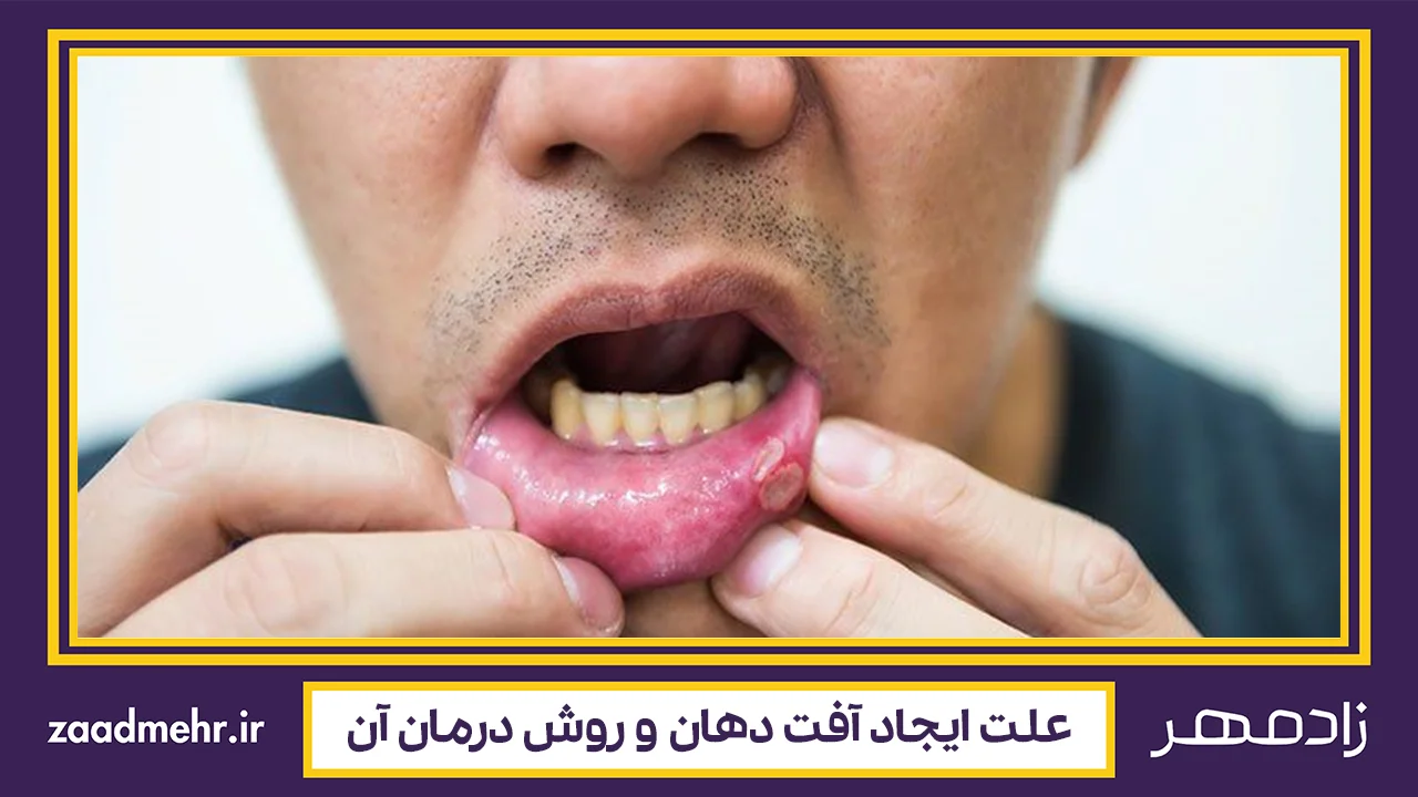 علت و درمان آفت دهان - Canker sores treatment and causes