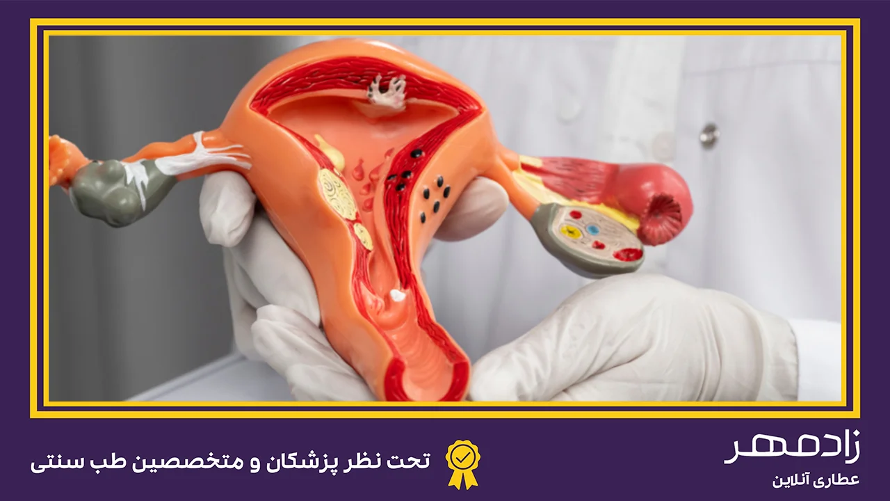 درمان تنبلی تخمدان یا سندروم پلی کیستیک - Polycystic ovary syndrome treatment