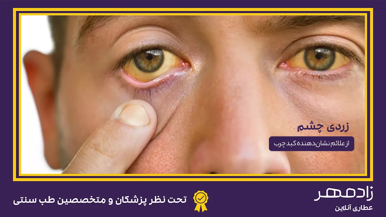زردی چشم از علائم چربی کبد - Yellow eye because fatty liver