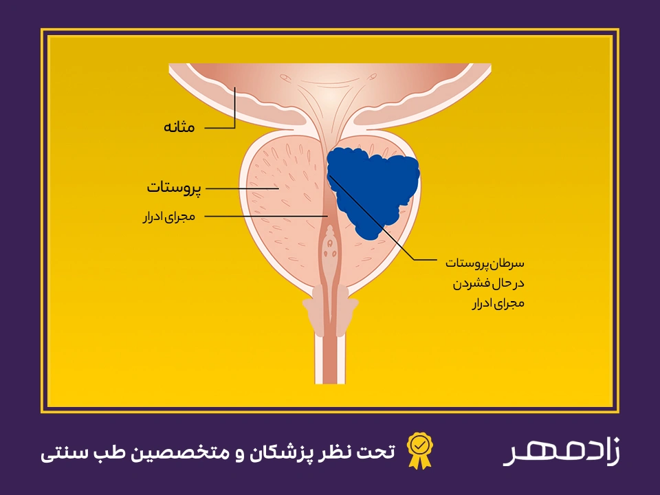 سرطان پروستات - Prostate cancer