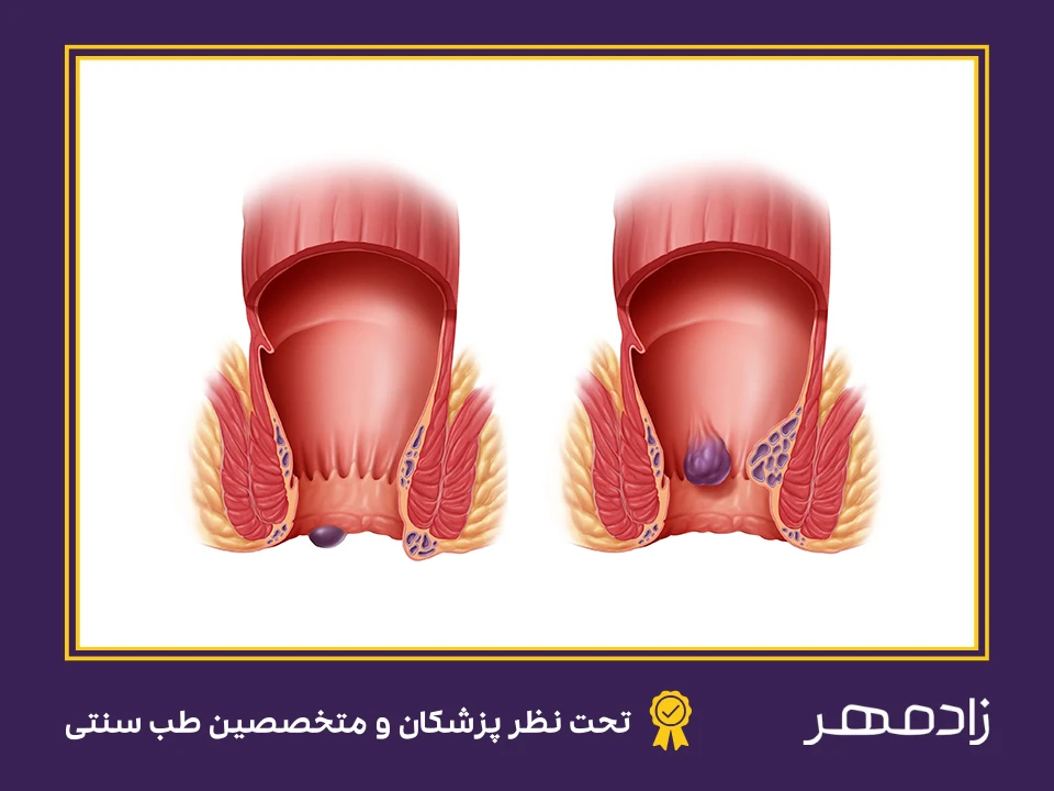 معرفی علائم بواسیر - Symptoms of hemorrhoids