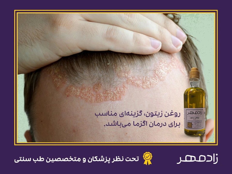 درمان اگزما با روغن زیتون - Eczema treatment with olive oil