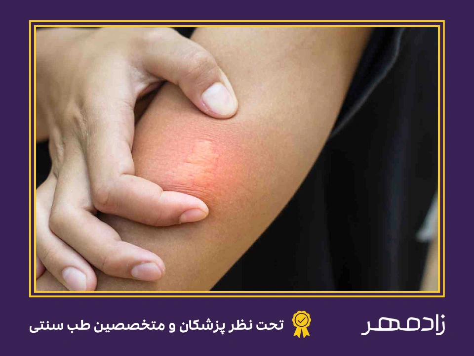 جای نیش زنبور - Bee sting site