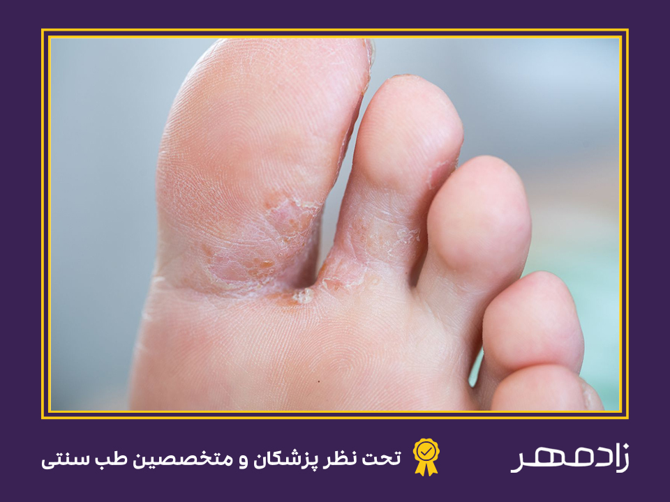 عرق سوز شدن انگشتان پا - Burning sweat feet finger