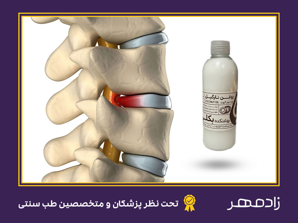 روغن نارگیل برای درمان درد دیسک کمر - Coconut oil for lumbar disc pain