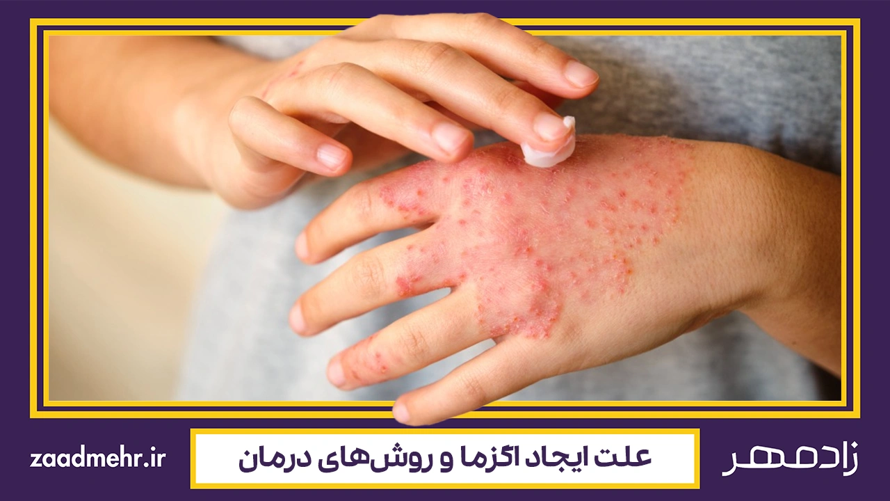 بیماری اگزما - Eczema disease