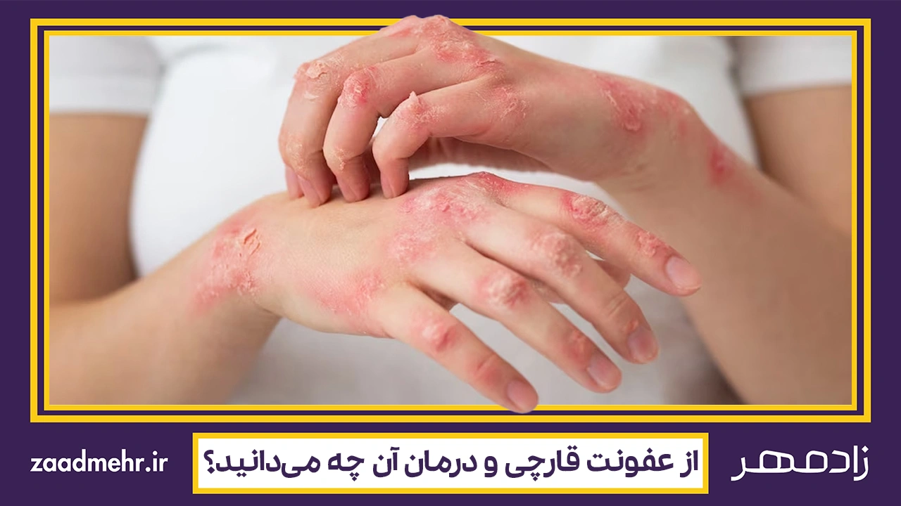 عفونت قارچی - Fungal infection