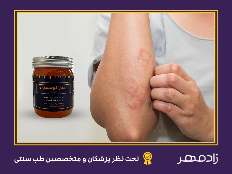 درمان اگزما با عسل - Honey for eczema treatment