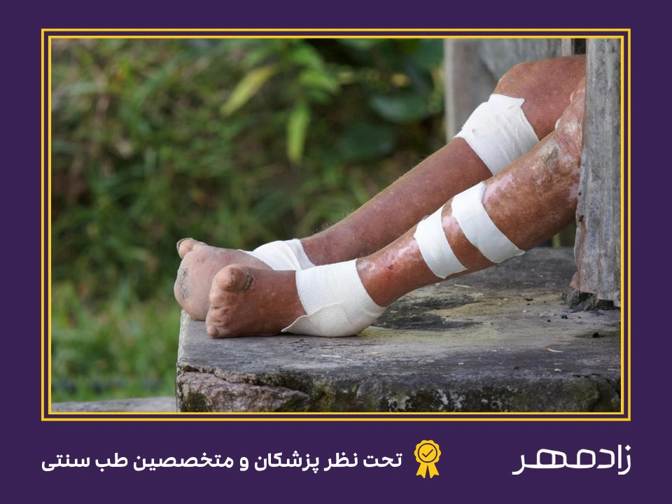 اثر جذام روی پا - Leprosy on feet