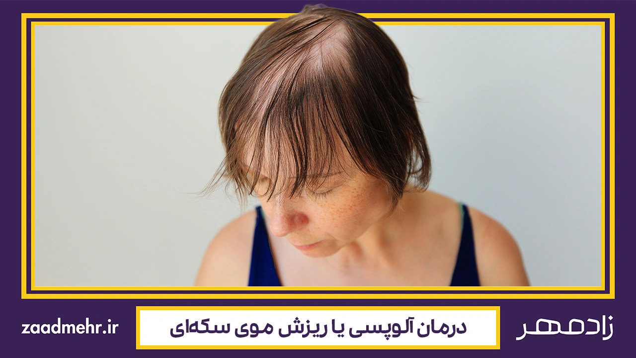 درمان آلوپسی - Alopecia treatment