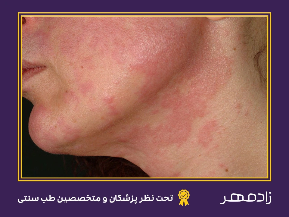 لوپوس پوستی - Cutaneous Lupus