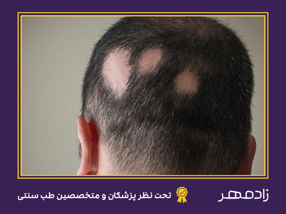 ریزش مو به علت آلوپسی - Hair loss because alopecia